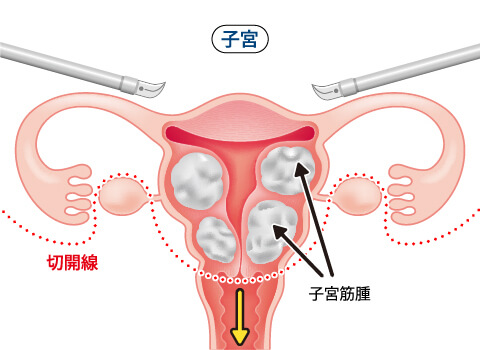 全腹腔鏡下子宮全摘術、腹腔鏡下腟式子宮全摘術